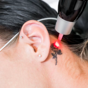 Borrado de tatuajes