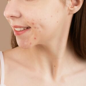 Tratamiento para piel grasa/acneica + limpieza facial de regalo