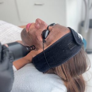 Hollywood peel